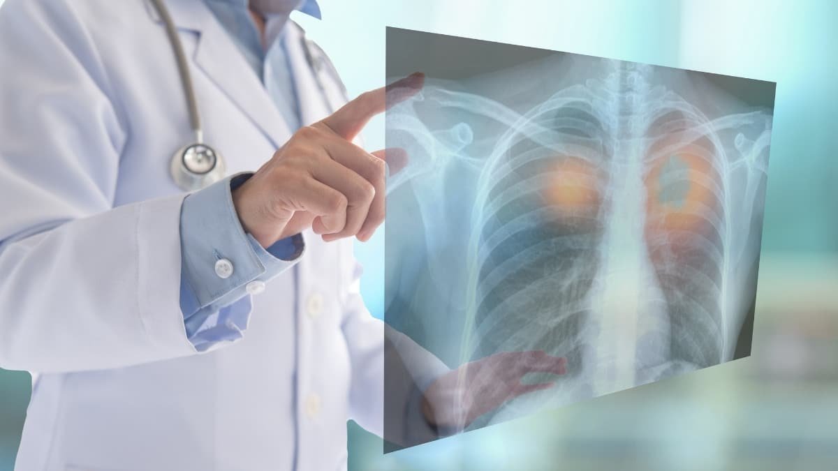Doctor diagnosing lung cancer