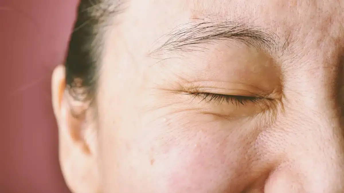 Dry skin around eyes